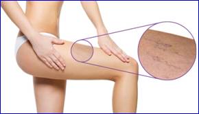 Las varices en las piernas